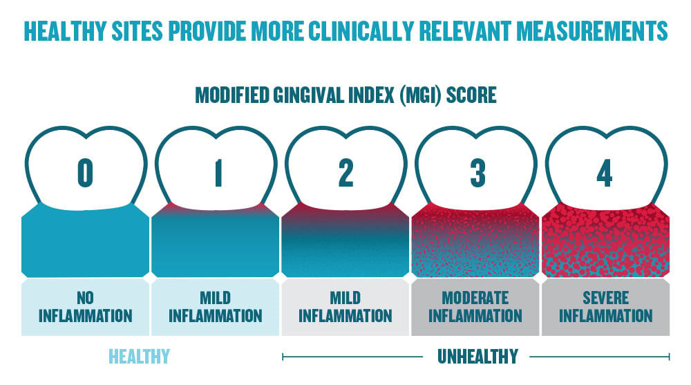 Infographic showing range of inflammation and modified gingival index
